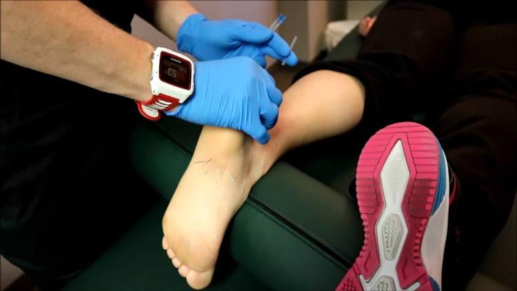 Dry Needling For Plantar Fasciitis in Towson MD