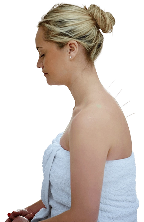 Chiropractic Towson MD Dry Needling Care Chiropractic Towson MD Dry Needling Care